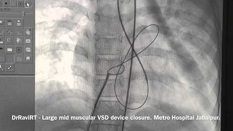 DrRaviRT - Large Mid Muscular VSD device closure