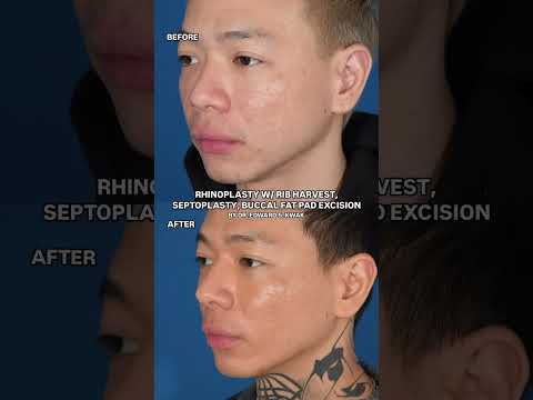 Video thumbnail: #NYCPlasticSurgeon #NYCPlasticSurgery #Rhinoplasty #Septoplasty #BuccalFatRemoval · Edward S. Kwak MD - ESKMD Facial Plastic Surgery