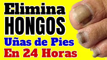 ¿Cómo eliminar las uñas oscuras de los pies de forma natural?