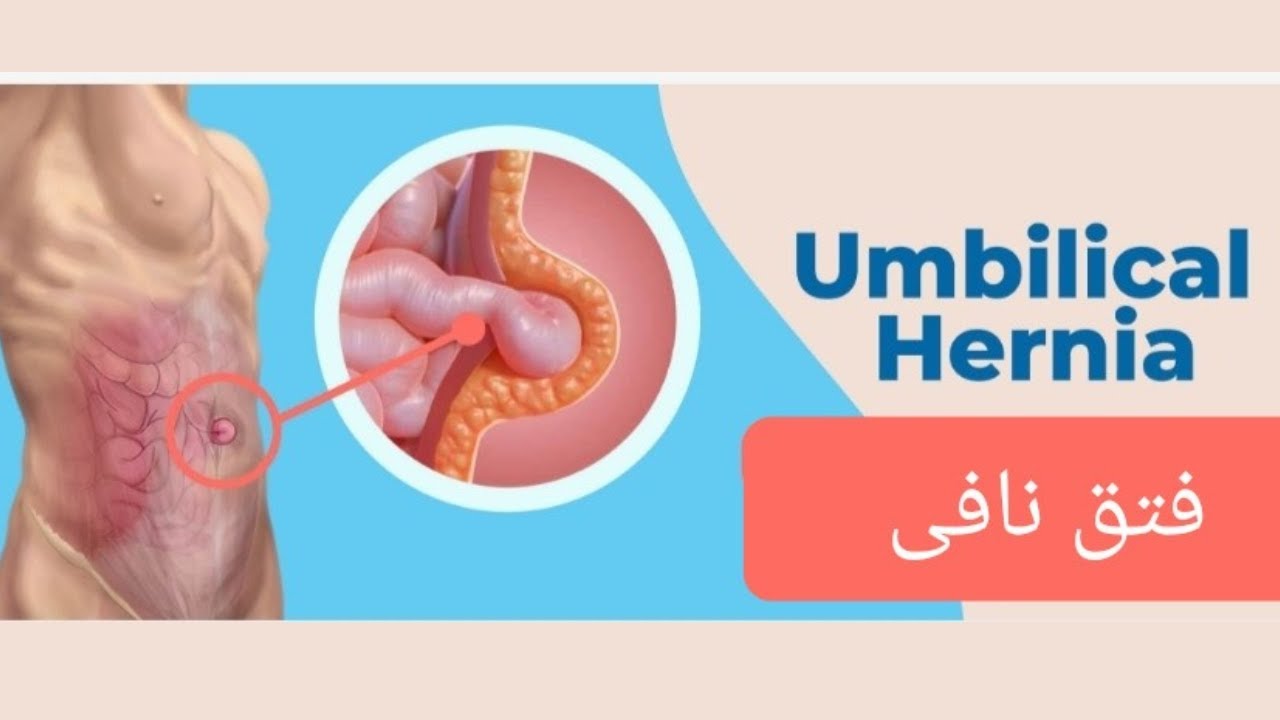 درباره فتق نافی بیشتر صحبت کنیم - YouTube