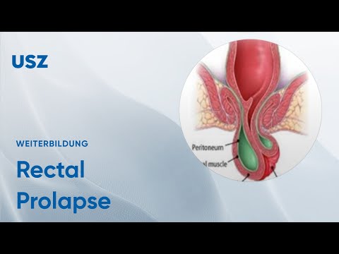 Rectal Prolapse – Please participate in our 3-minute survey below!