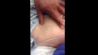 Difficult IV access? Use the shoulder vein (Vein of Hughes)