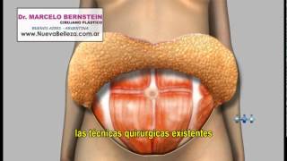 Cirurgia Abdominoplastia - Dr. Davi Pontes - Fortaleza Natal São Luis - Cirurgia Plástica