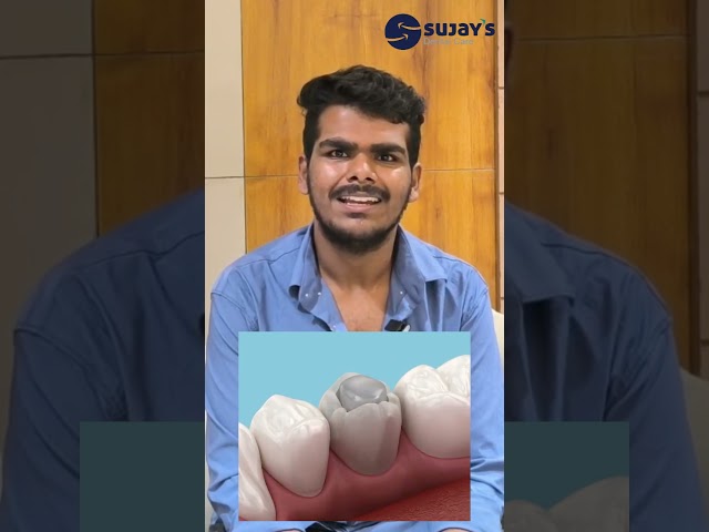 Root Canal Treatment and Dental Crown Restores Mounesh’s Smile | Sujay Dental Care