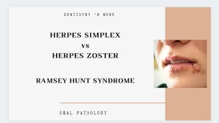 HERPES SIMPLEX Vs HERPES ZOSTER