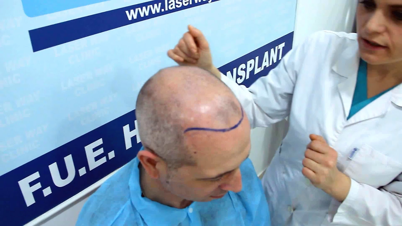 Hair transplant in Albania Kosovo . Trapianto capelli a Tirana nella