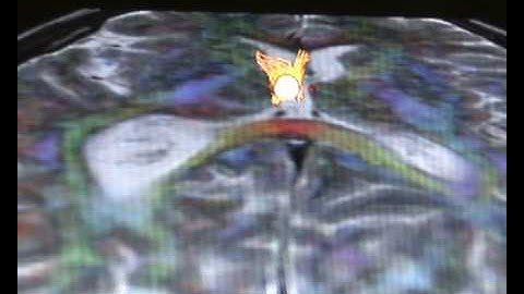 Exploring brain connectivity - Fibertracking