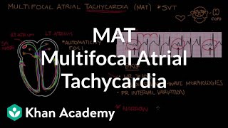 Multifocal atrial tachycardia (MAT) | Circulatory System and Disease | NCLEX-RN | Khan Academy