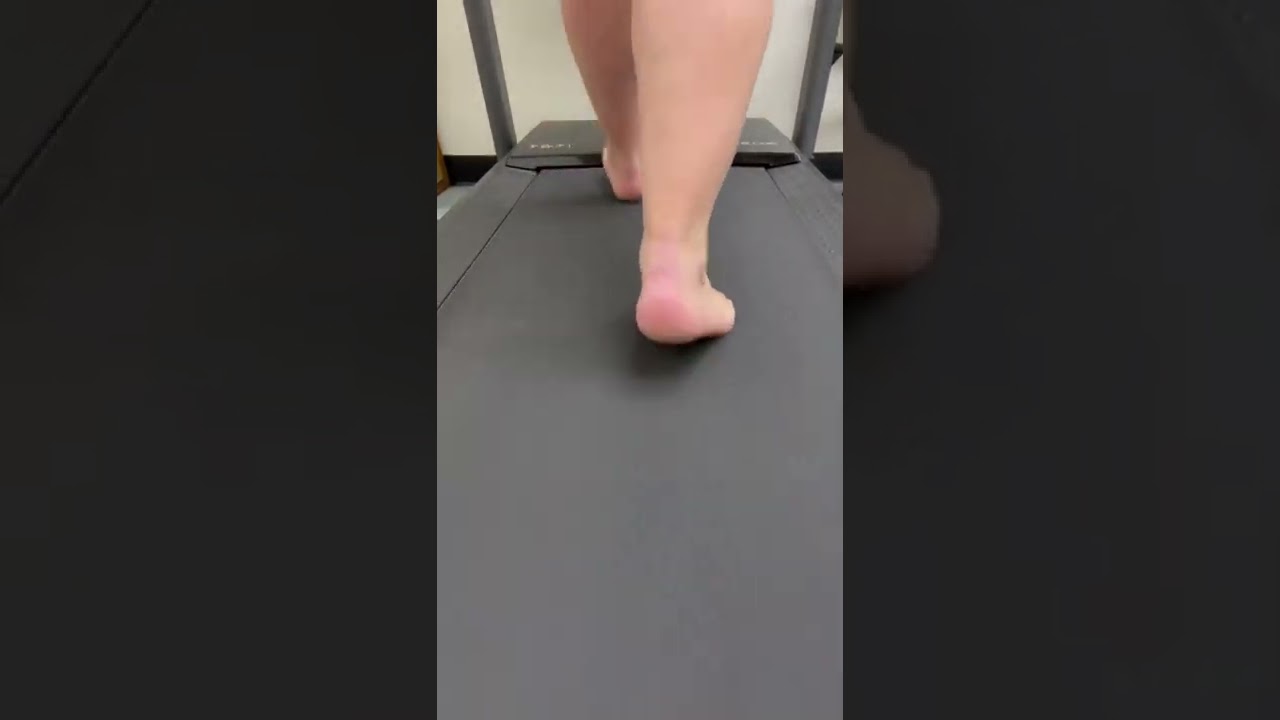 A biomechanical reason why this patient had a non contact ACL tear and 2 failed revisions.