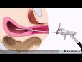 عملية منظار الرحم Hysteroscopy 