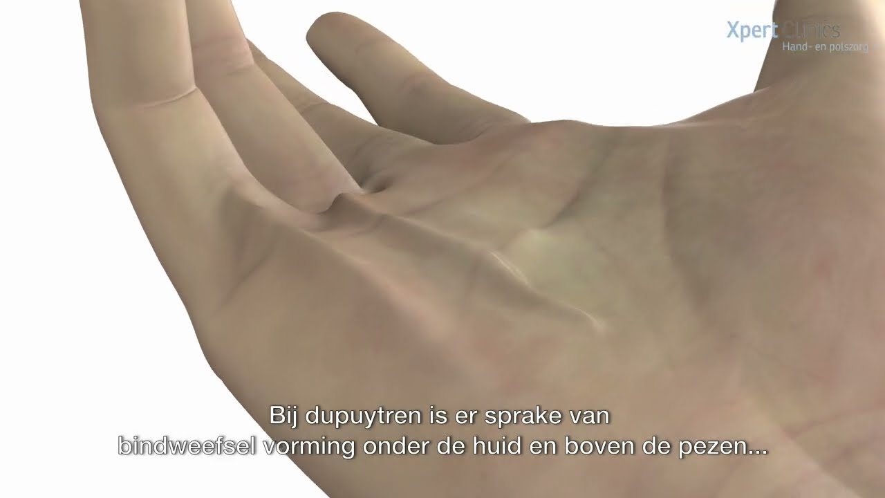 Behandeling Dupuytren - Xpert Clinics