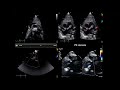 Echocardiography in Congenital Heart Disease