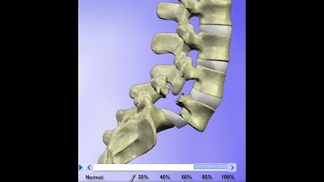 Spondylolisthesis explained