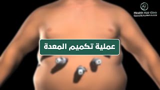 عملية تكميم المعدة مع فحص التسريب | خطوات اجراء عملية تكميم المعده في تركيا | الدكتور محمد حاج موسى