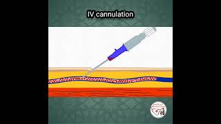 💉 INTRAVENOUS (IV) CANNULATION ANIMATION | IV ACCESS, INJECTION