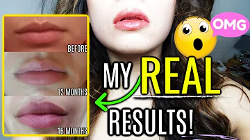 How To Get Plump Lips PERMANENTLY! | *BEFORE AND AFTER*