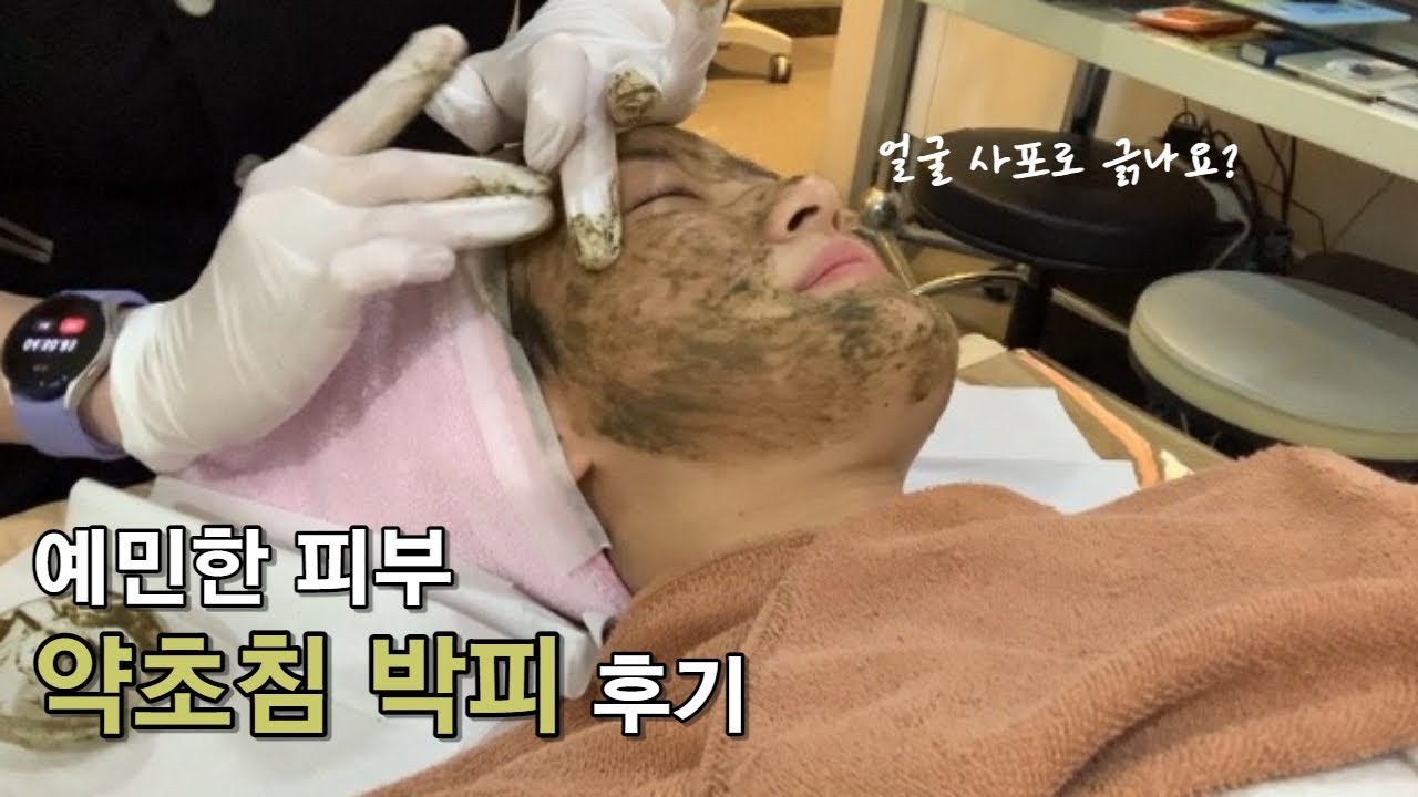 (SUB) 여드름 흉터&자국 치료 | FCR 필링 후 1주일 후기😱