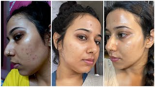 How I am Clearing my PIMPLES,ACNE , TINY BUMPS So Quickly | Simple  affordable, 3-steps Skincare