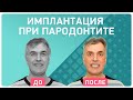 Имплантация при пародонтите 👉 отзыв пациента спустя год после лечения