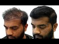 Transformation journey canada to india for hair transplant  new roots hair clinic nagpur 
