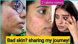 SHARING MY ACNE STORY | STRUGGLES,PIMPLE TREATMENTS ! ACNE REMOVAL & CURE ? | TAMIL | Episode 1