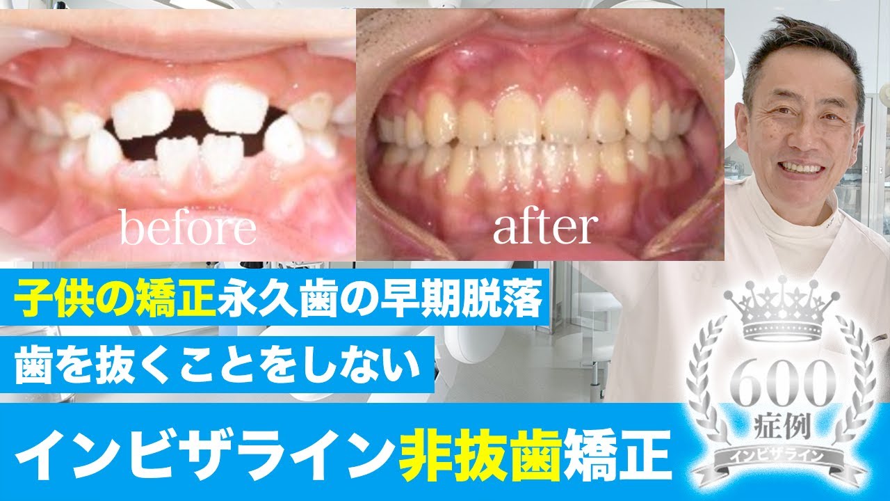非抜歯矯正 子供の矯正 乳歯の早期脱落によりスペースが足りない症例 歯を抜くことを基本的にしない矯正歯科の症例紹介 700症例実績インビザラインドクター Youtube