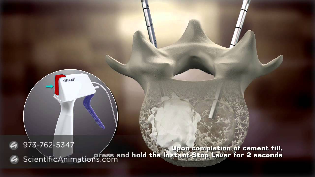 Bone Cement Procedure - Spine Animation - YouTube