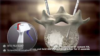 Bone Cement Procedure - Spine Animation