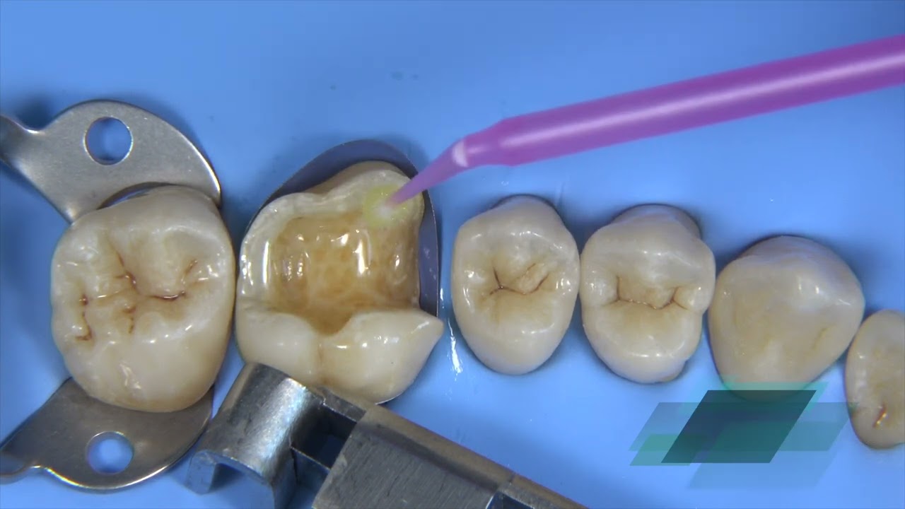 GC Indirect Restorative Solutions - Deep Margin Elevation