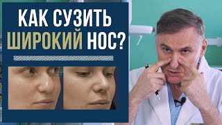 КАК СУЗИТЬ ШИРОКИЙ НОС: 💉УКОЛЫ ИЛИ ОПЕРАЦИЯ?