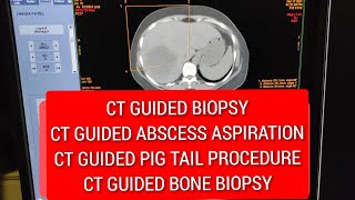 How to do Marking for CT Guided Biopsy, CT Guided Pig Tail, CT Guided Abscess Aspiration Protocol.