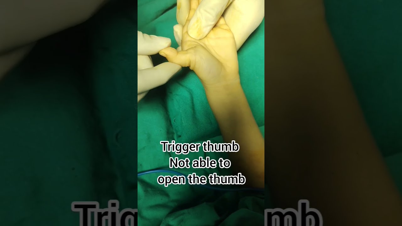Trigger Thumb Is A Condition In Which Child Not Able To Open Can Be Treated Surgically