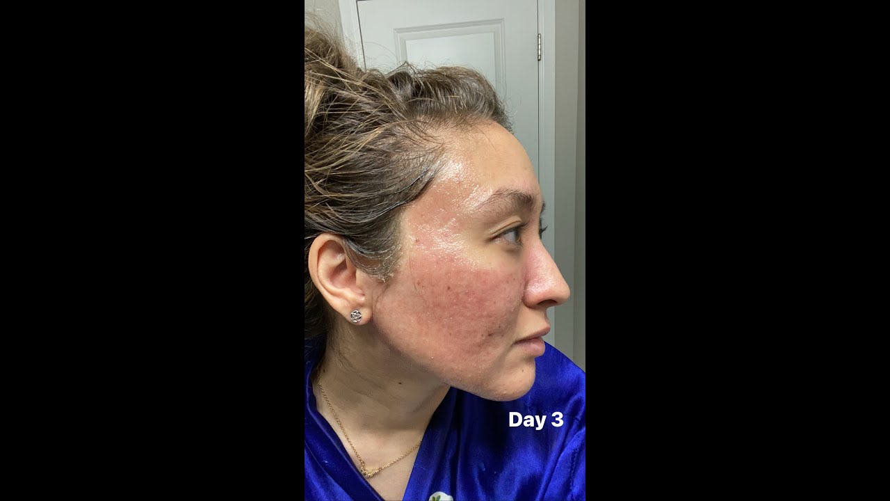CO2 Laser Acne Scars Before/After YouTube
