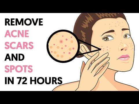 How to Get Rid of Acne Scars and Spots in  Hours!