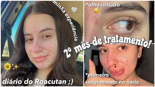 SEGUNDO MÊS TOMANDO ROACUTAN!💗 |diário do Roacutan