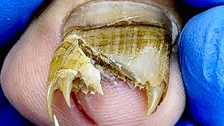 The Toenail Has Grown Two Horns, Fix It!【Xue Yidao】