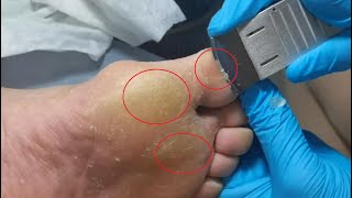 Three big Callus removal from feet. Dead skin removal and Cracked heels treatment. Foot care.