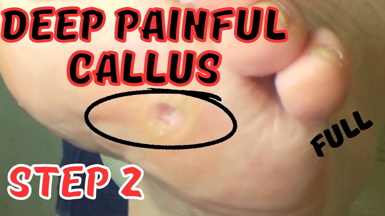 Deep painful callus removal. Step 2 YouTube