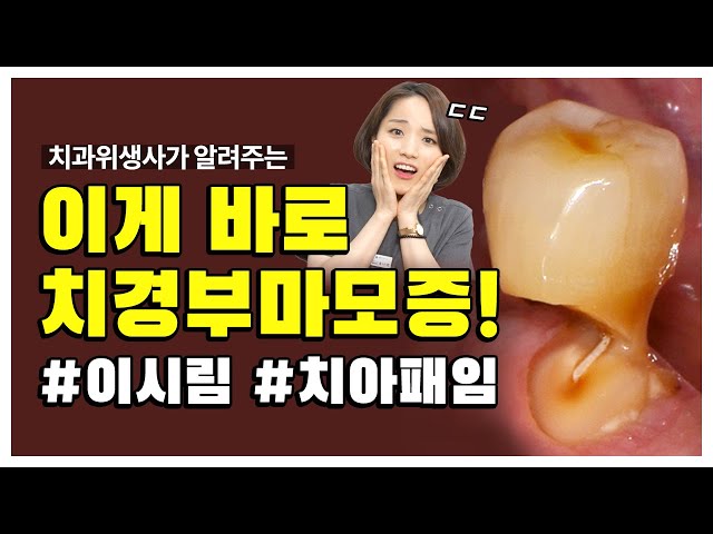 치과위생사가 알려주는 시린 이, 치경부마모증(치아패임)🥶 | 레진치료