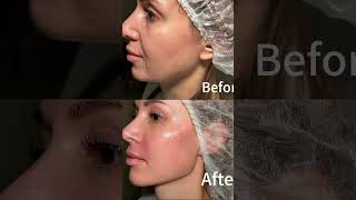 Facial contouring
