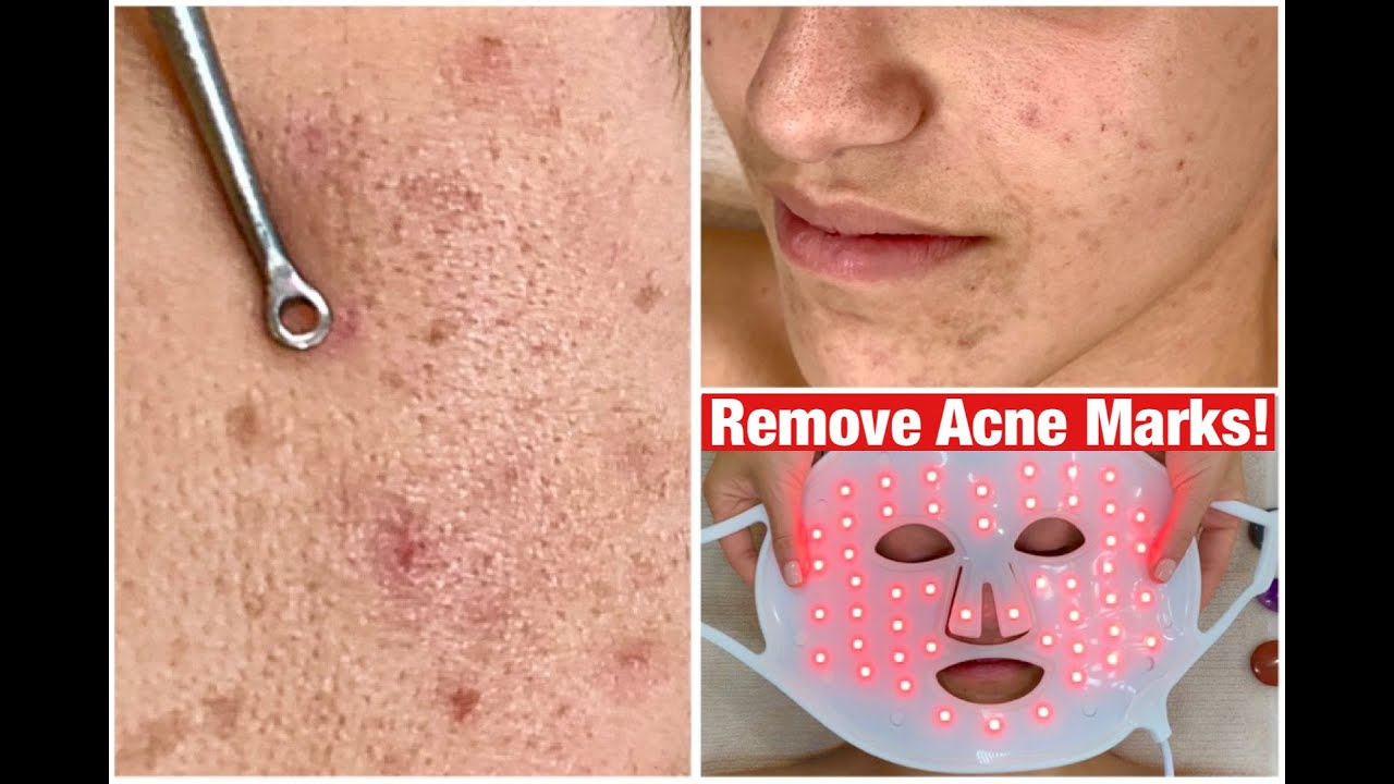 Stubborn Acne And Dark Marks Removal Facial Jadeywadey180 Youtube