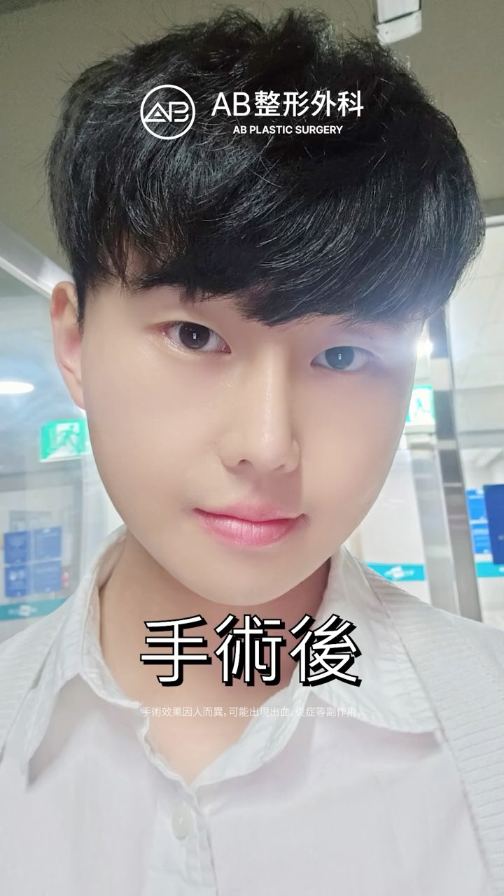 輪廓三件套＋眼部整形＋隆鼻變帥了！ #Shorts