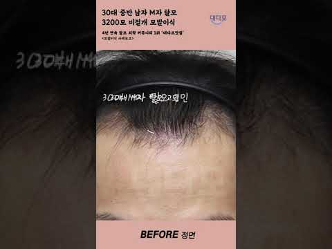 30대 중반 남자 M자 탈모, 비절개 모발이식 3200모 1년 후기 <strong>Before</strong> &amp;<strong>amp</strong>; <strong>After</strong> [#shorts]