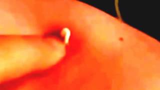 Blackhead squeezing 2015 video blackhead and cysts video removal 2015 YouTube YouTube