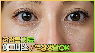 한관종 치료 횟수 , 시술 주기 아그네스 얼굴에 붉은 기운 걱정 끝 #한관종