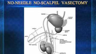 No-Needle No-Scalpel Vasectomy