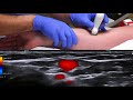 Ultrasound-guided peripheral venous cannulation