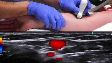 Ultrasound-guided peripheral venous cannulation