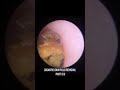 #ear #audiologyassociates #earwax #earwaxremoval #earcleaning