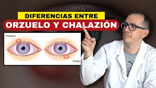 OPHTHALMOLOGIST EXPLAINS THE DIFFERENCES BETWEEN STYES AND CHALAZIONS / Doctor Ojo 🥼🩺👁